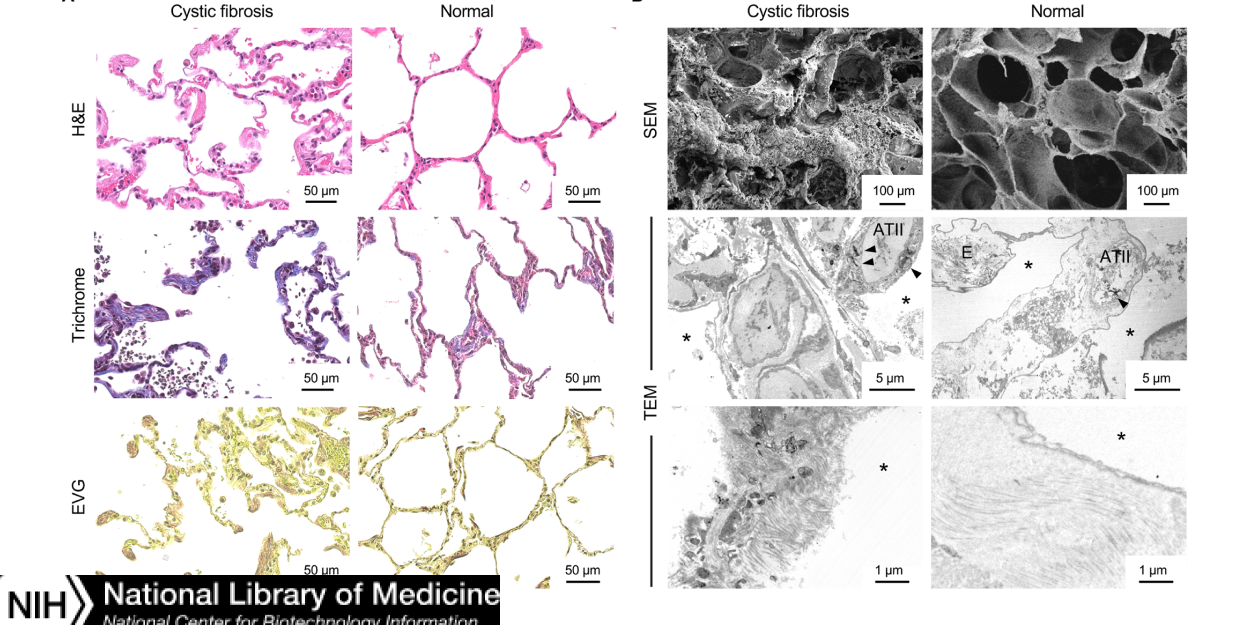 Pathological Remodeling of Distal Lung Matrix in End-Stage Cystic Fibrosis Patients