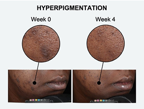 Improve the appearance of hyperpigmentation &amp; age spots