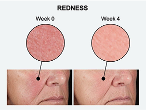Visibly reduce redness
